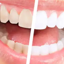 Diş Beyazlatma (Bleaching) ile İlgili Merak Edilenler